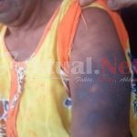Diduga Oknum Perawat PKM Bontomatene Yang Beri Obat, Wajah Dan Tubuh Pasien Dipenuhi Bintik Hitam