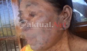 Pasien PKM Bontomatene Mengalami Bintik Hitam Pada Tubuhnya, LPK-Sul-Sel Angkat Bicara